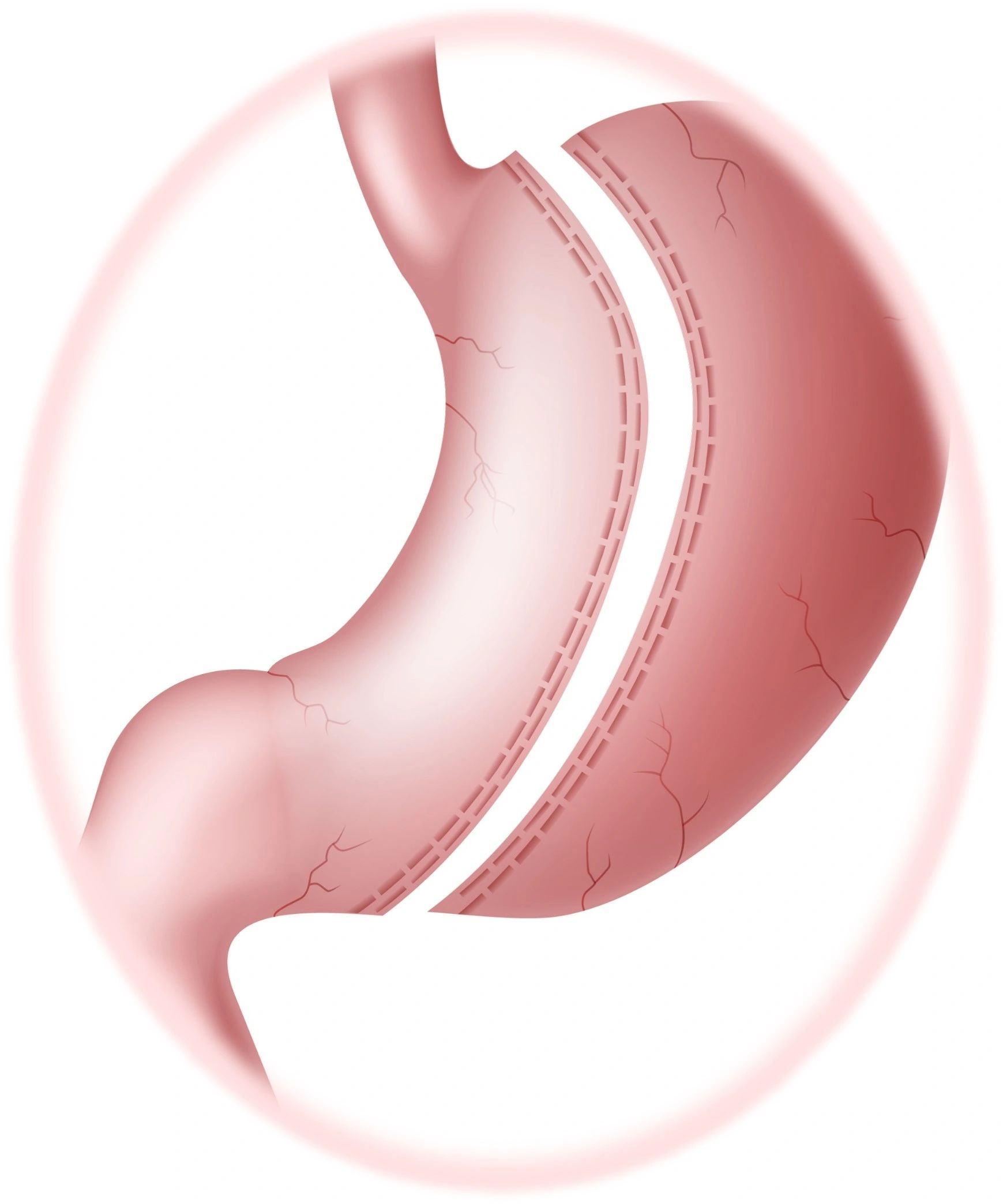 Sleeve Gastrectomy Who What Where And Why sleeve-gastrectomy-who-what-where-and-why